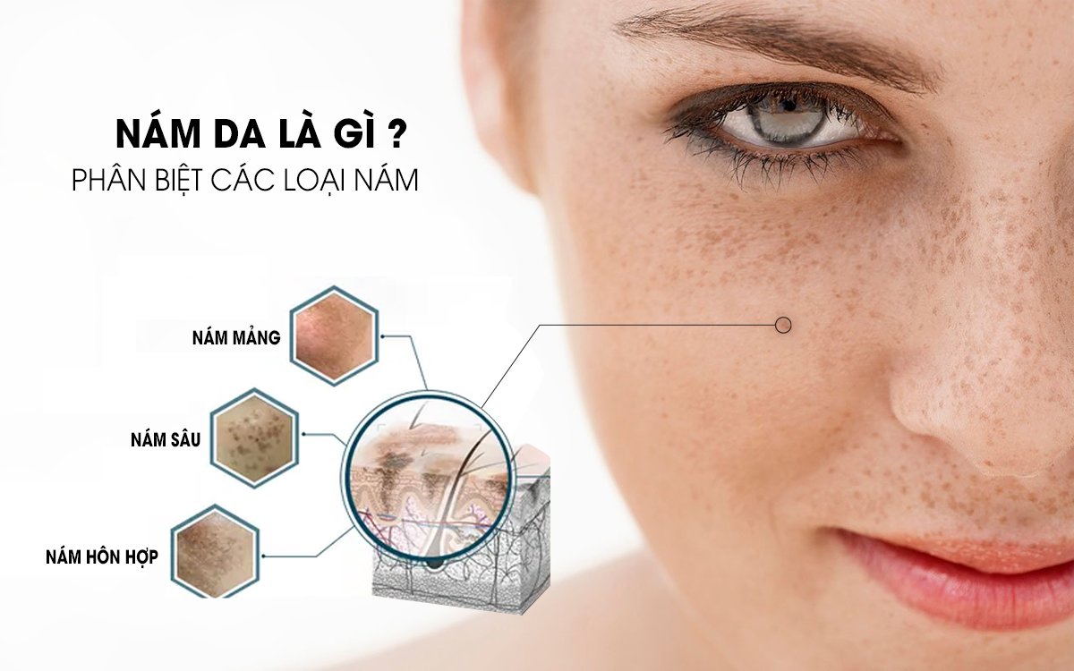 Cách chữa nám da hiệu quả và an toàn - Bio cosmetics Mỹ Phẩm Sạch