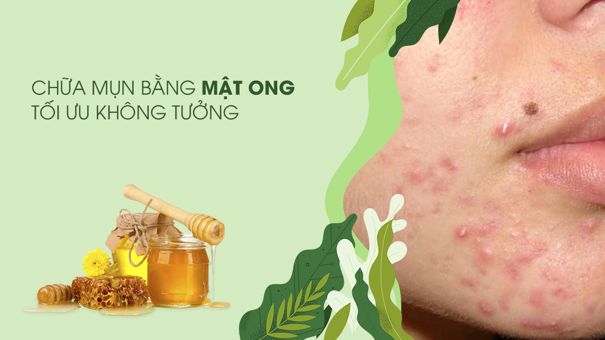 chua-mun-bang-mat-ong