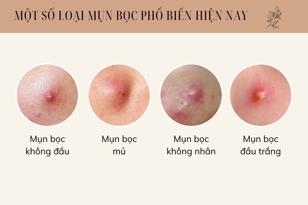 mot-so-loai-mun-boc-pho-bien-hien-nay