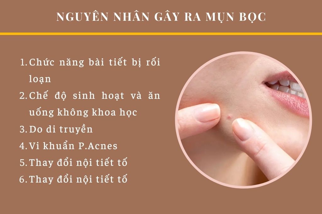 Nguyên Nhân Gây Ra Mụn Bọc: Tìm Hiểu Để Giải Quyết Hiệu Quả